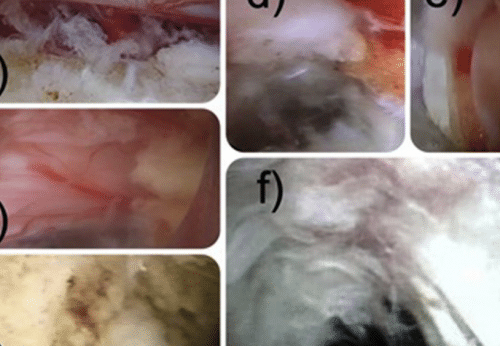 Dysethesia due to irritation of the dorsal root ganglion following lumbar transforaminal endoscopy: Analysis of frequency and contributing factors