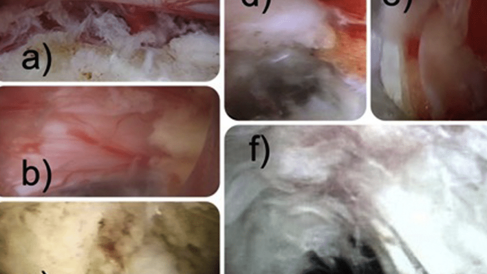 Dysethesia due to irritation of the dorsal root ganglion following lumbar transforaminal endoscopy: Analysis of frequency and contributing factors