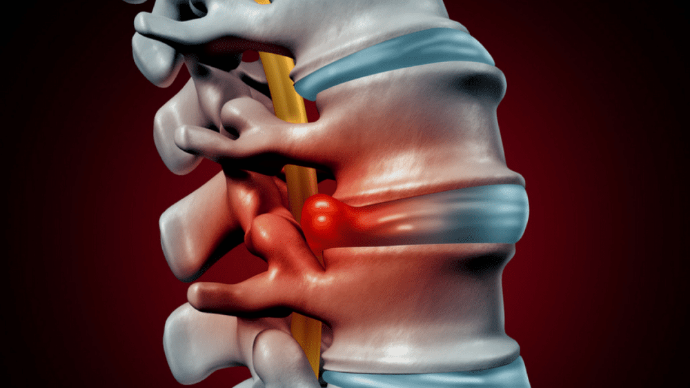 Discopatia Degenerativa: O que é, Causas, Sintomas, Diagnóstico e Tratamento