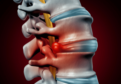 Discopatia Degenerativa: O que é, Causas, Sintomas, Diagnóstico e Tratamento