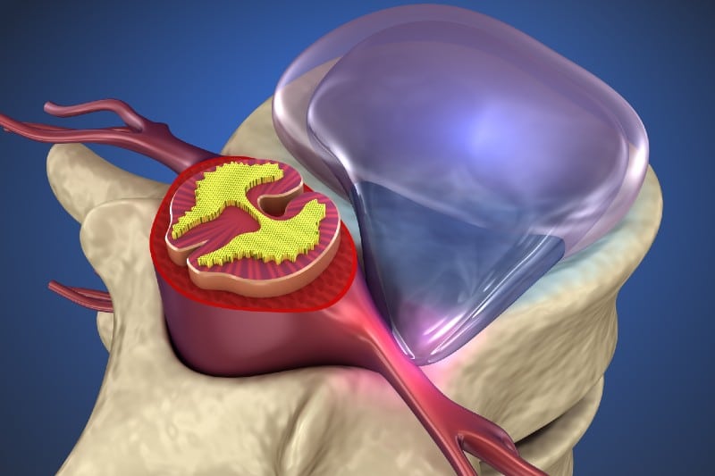 Hérnia de Disco Extrusa: Causas, Sintomas e Tratamentos