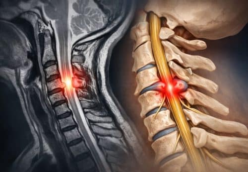 Mielopatia Cervical: Sintomas, Causas e Tratamentos