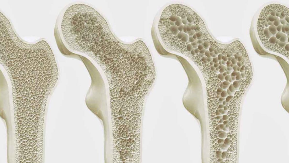 Osteoporose: Compreenda os Riscos e Tratamentos