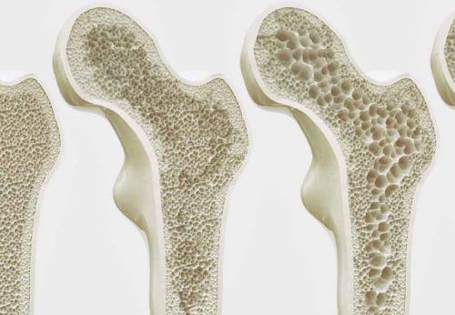 Osteoporose: Compreenda os Riscos e Tratamentos