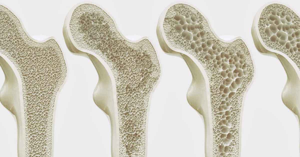 osteoporose